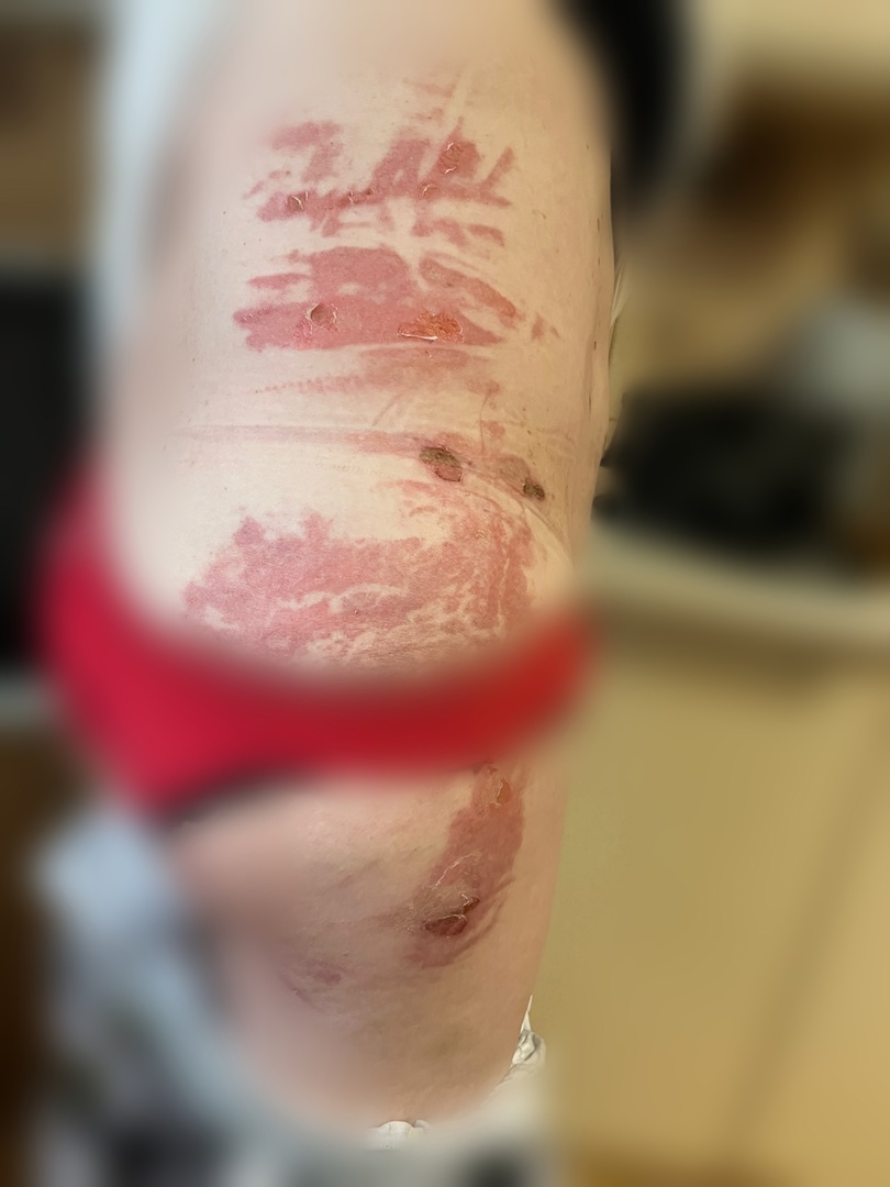 В городе Рязани в ресторане на сотрудницу вылили кипяток из 10-литровой кастрюли