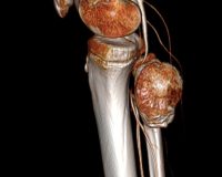 операция на ноге