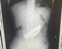 проглотил магниты